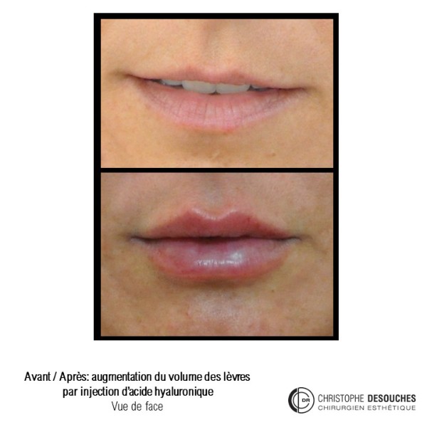 Lip augmentation / lip augmentation by injection of hyaluronic acid