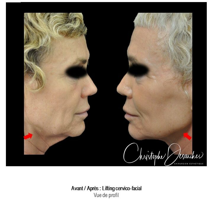 cervico-facial lifting