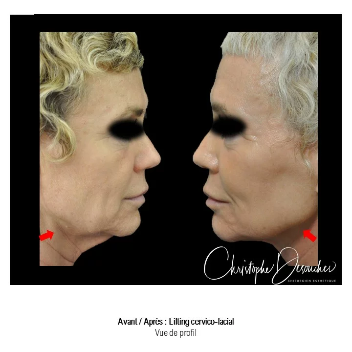 lifting cervico-facciale