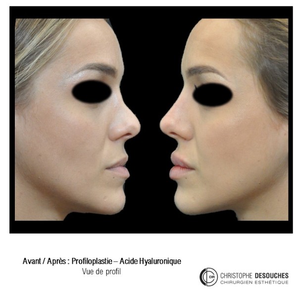 Medical profiloplasty - injections of hyaluronic acid