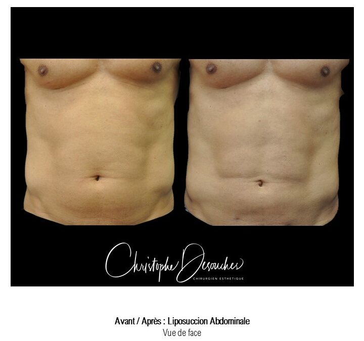 Liposuccion ventrale avant après