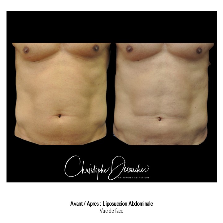 Ventral liposuction