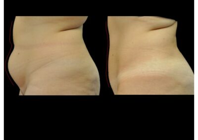 Liposucción de abdomen