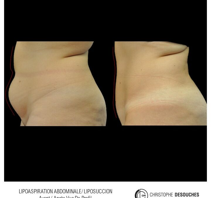 Liposuccion abdominale avant après
