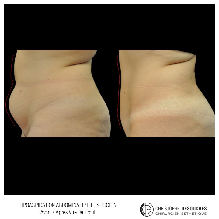 Abdominal liposuction