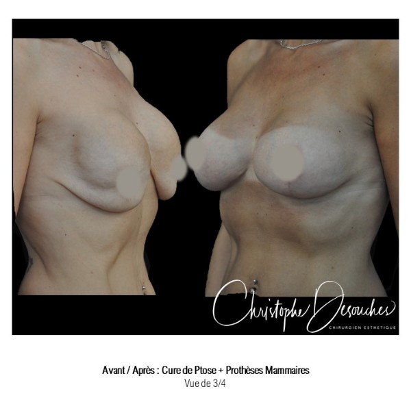 Cure of breast ptosis plus prostheses