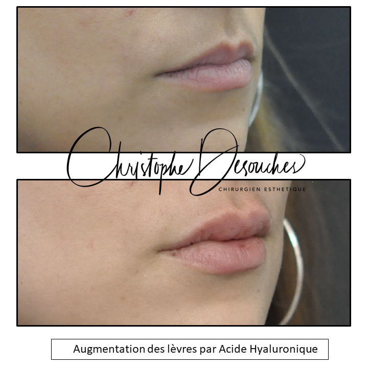 Avant/après augmentation des lèvres par injection d'acide hyaluronique, vue de face – Dr Desouches, Marseille