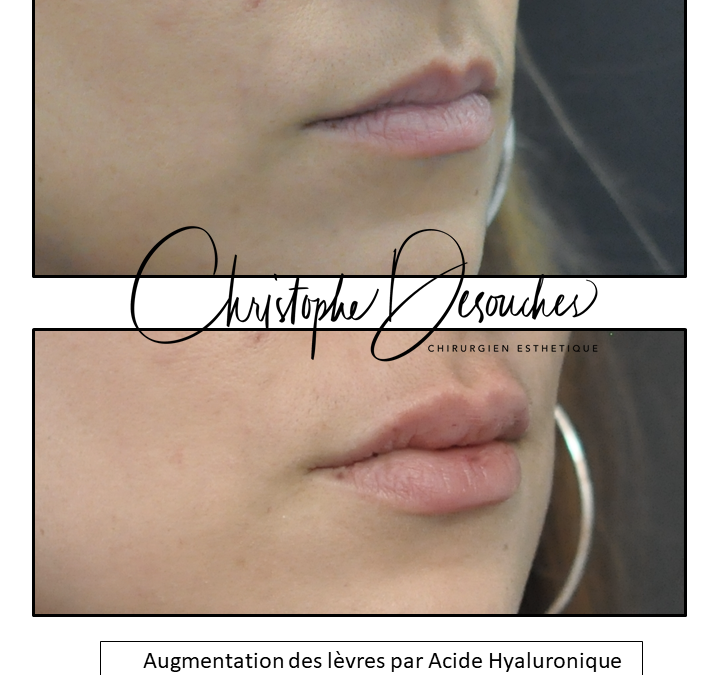 lip augmentation