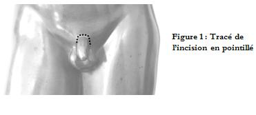 Penile lengthening