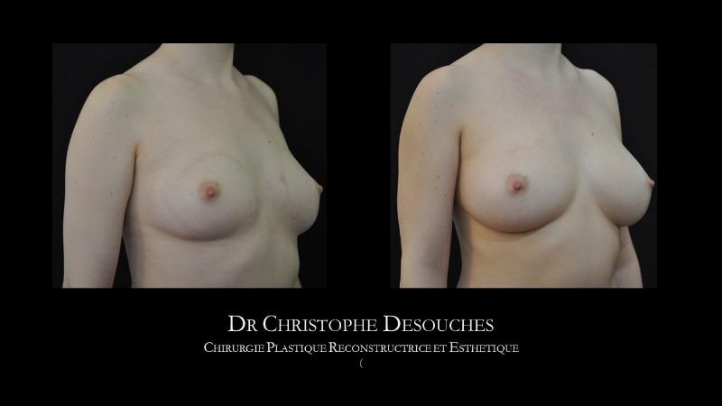 Breast augmentation by lipofilling