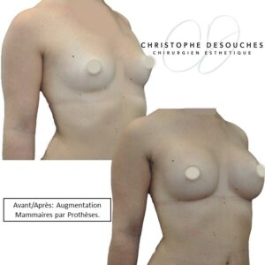 Breast prostheses 