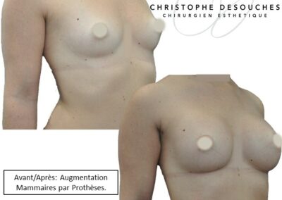 breast prosthesis