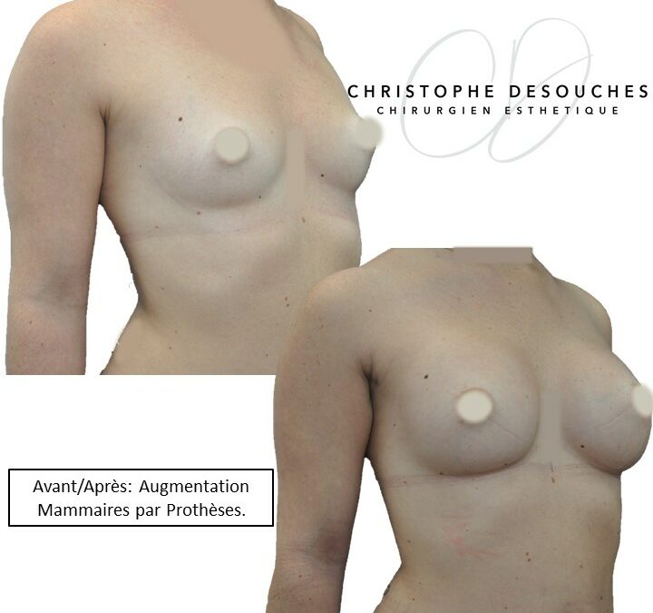 breast prosthesis