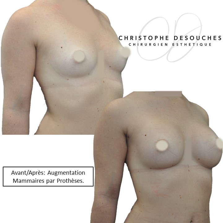 breast prosthesis