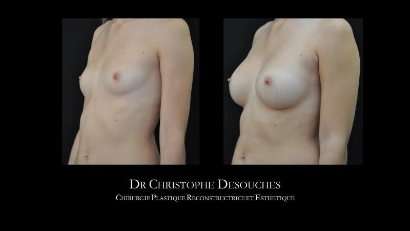 Breast augmentation by prosthesis