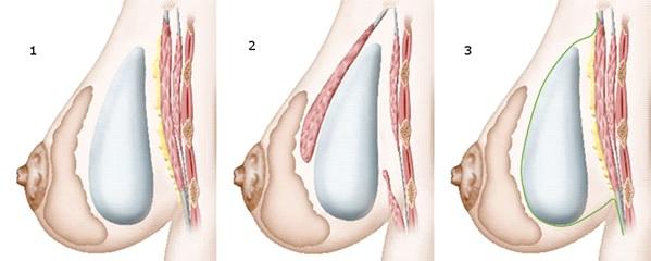 implantes