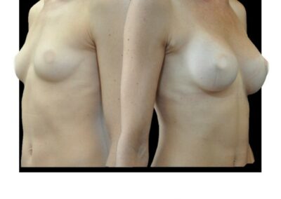 Breast augmentation by prosthesis