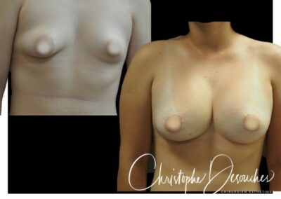Breast prostheses and round block