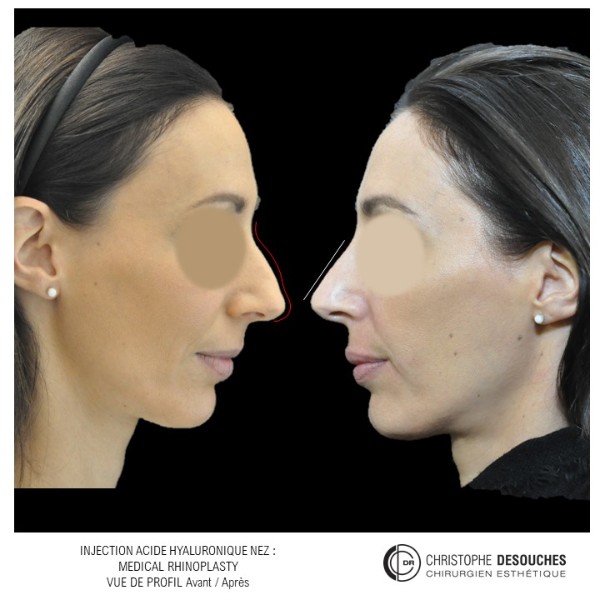 Rhinoplastie médicale : injections d’acide hyaluronique pour corriger le profil nasal