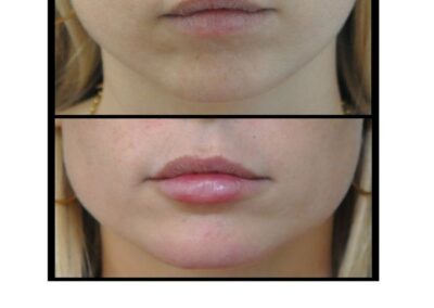 Увеличение губ/увеличение губ инъекциями гиалуроновой кислоты