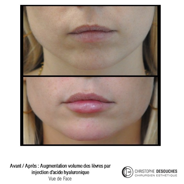 Lip augmentation / lip augmentation by injection of hyaluronic acid