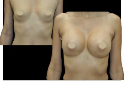 Увеличение груди протезом