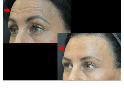 Botox