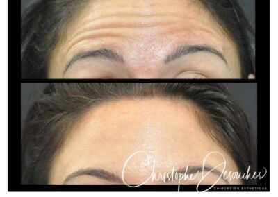 Botulinum toxin injections in the forehead - Reducing expression lines with botox