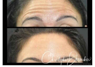 Iniezioni di tossina botulinica sulla fronte – Ridurre le rughe d'espressione con il botox