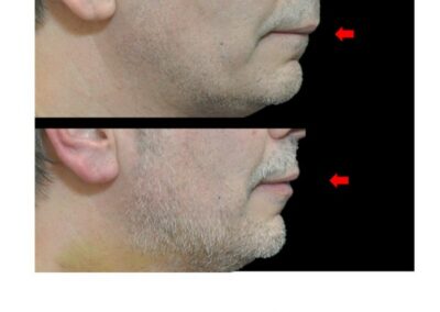 Aumento del volume delle labbra negli uomini