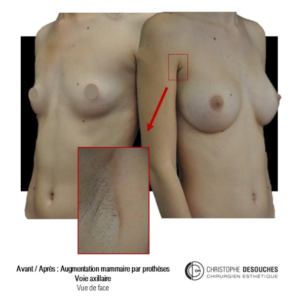 Aumento mamario mediante prótesis por vía axilar