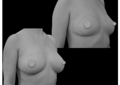 lipofilling mamario