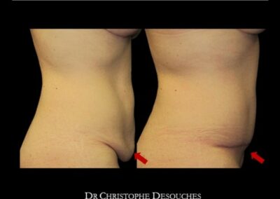 ABDOMINOPLASTIA