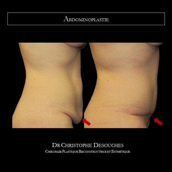 ABDOMINOPLASTIE