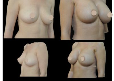 breast augmentation with prostheses