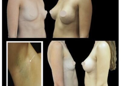 Aumento mamario mediante prótesis, abordaje axilar, prepectoral y subfascial