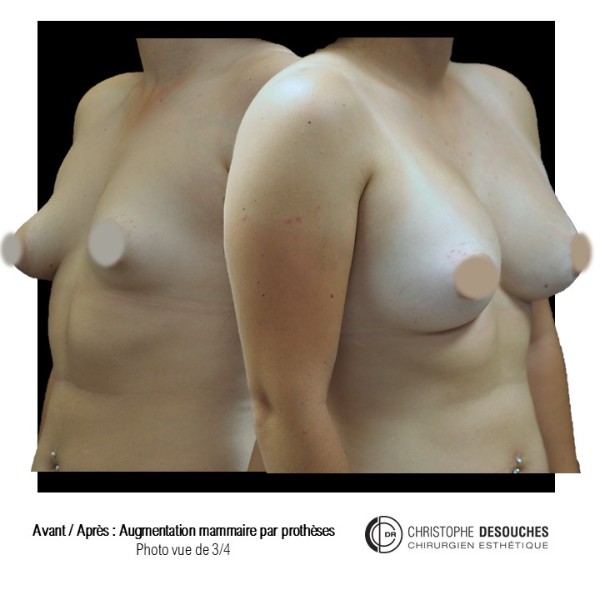 Harmonization of the female bust using prostheses