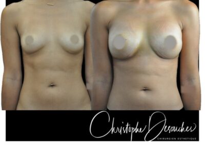 Breast volume increase by prostheses