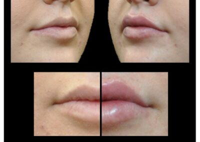 Increase in lip volume by injection of hyaluronic acid
