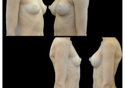 Augmentation mammaire par prothese par voie axillaire