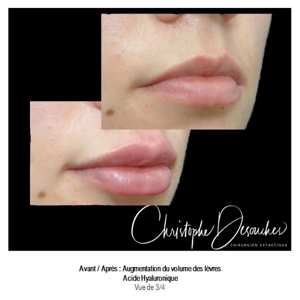 Increase in lip volume thanks to injections of hyaluronic acid
