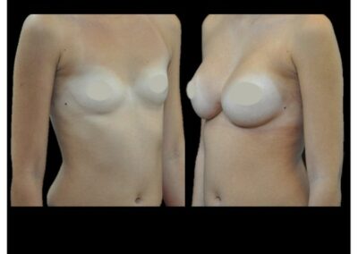 breast augmentation by prosthesis
