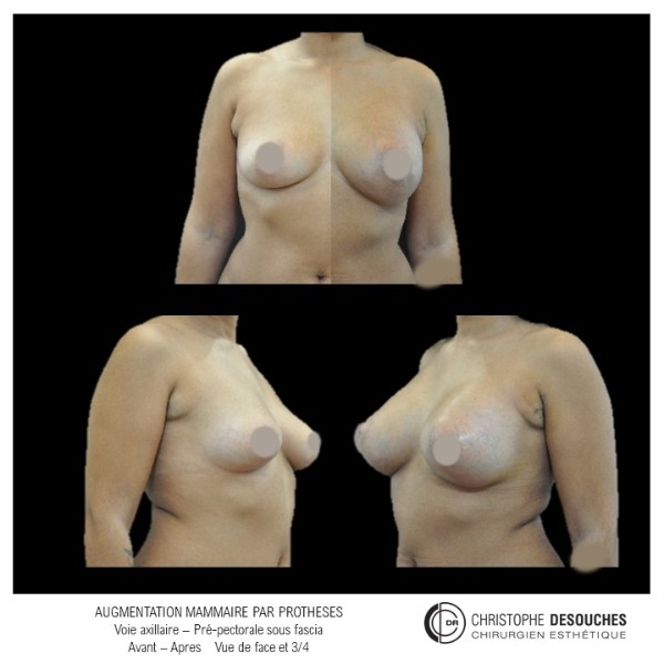 Breast augmentation by axillary prosthesis