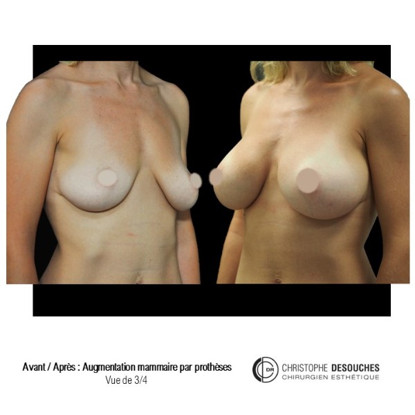 Breast augmentation with prosthesis - 3/4 view