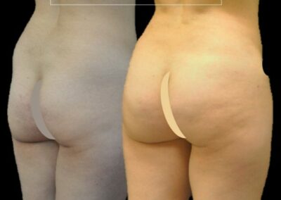 lipofilling de glúteos / levantamiento de glúteos brasileño