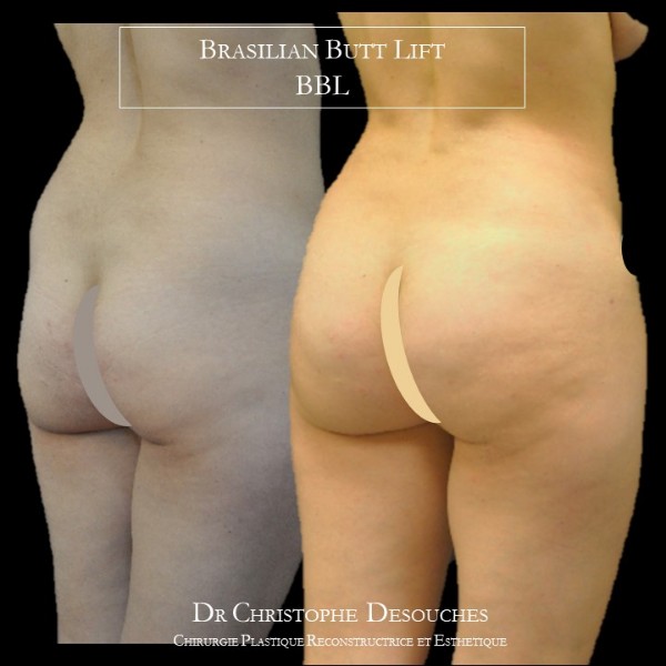 buttocks lipofilling / brazillian butt lift