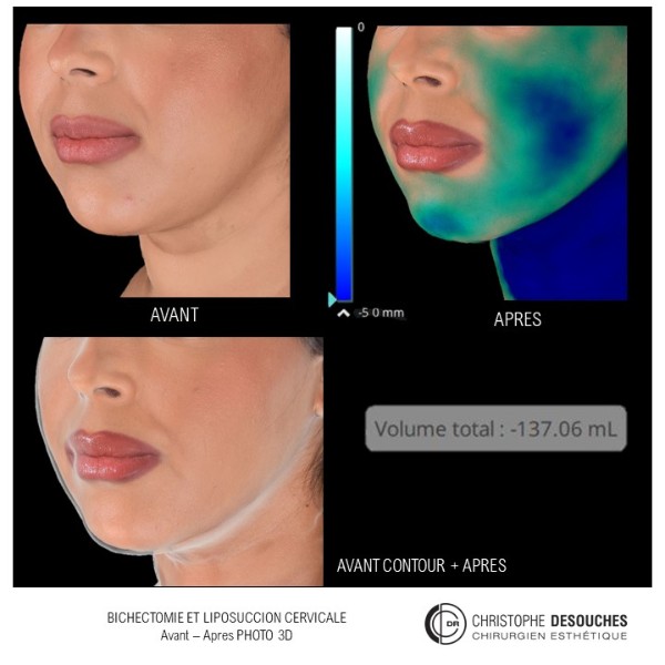 BICHECTOMY AND LIPOSUCTION OF THE NECK