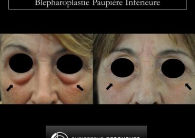 Blefaroplastica palpebrale inferiore
