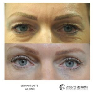 Eyelid surgery in Marseille