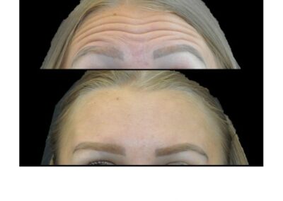 Botox